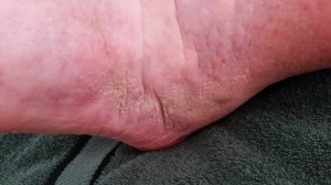 Poor skin care on Lymphoedema foot 