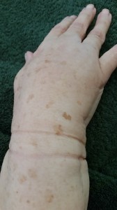 Hand Lymphoedema