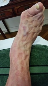 Lymphoedema of the foot. Note indentations after compression removed. 